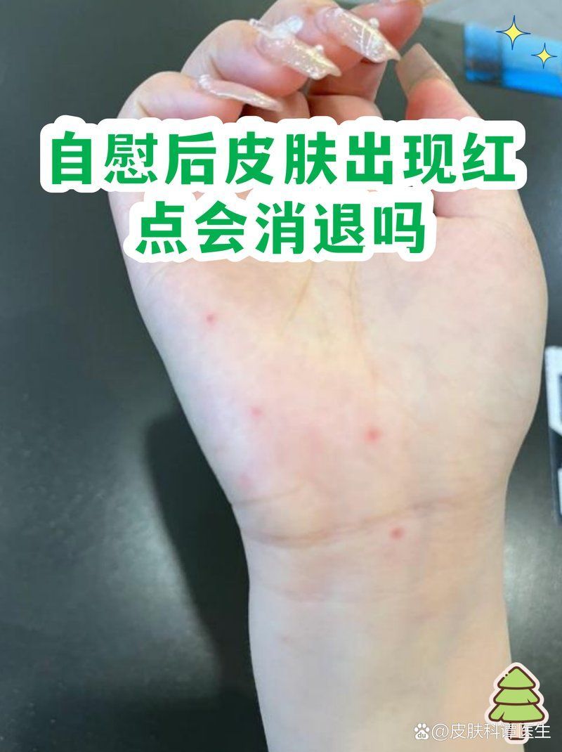 生理性紅點(diǎn)會(huì)自行消失嗎，性紅點(diǎn)會(huì)自行消失嗎？