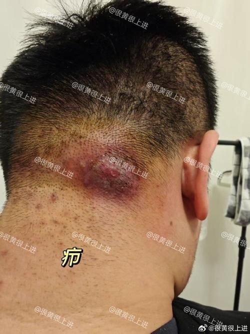 真菌和細菌感染的治療方法有哪些