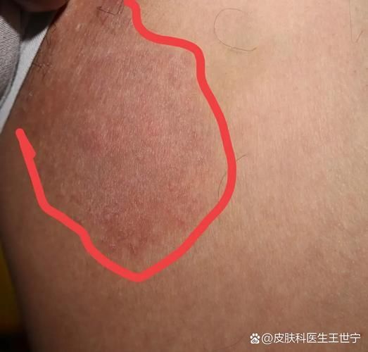 真菌和細菌感染的治療方法有哪些