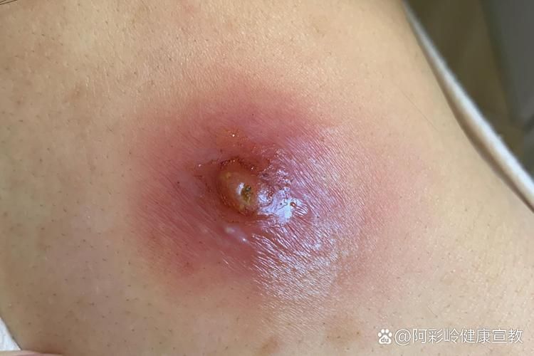 真菌和細菌感染的治療方法有哪些