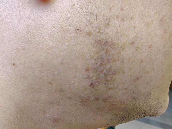 感染性斷須治療周期多久