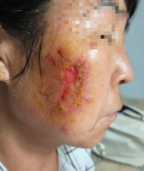 如何判斷海水細菌感染的嚴重程度，如何判斷海水細菌感染