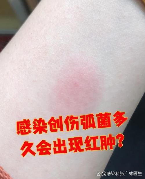如何判斷海水細菌感染的嚴重程度，如何判斷海水細菌感染