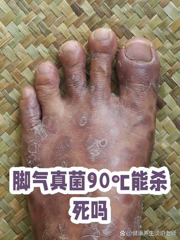 高溫消殺真菌的具體溫度是多少，消殺真菌的具體溫度取決于所要消殺的具體溫度取決于所要消殺的真菌