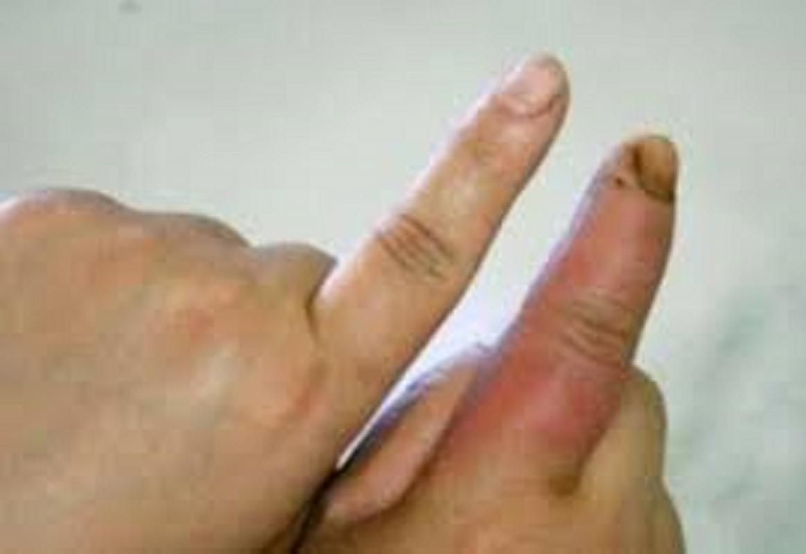 海洋弧菌感染早期圖片，感染海洋弧菌后多久會出現癥狀