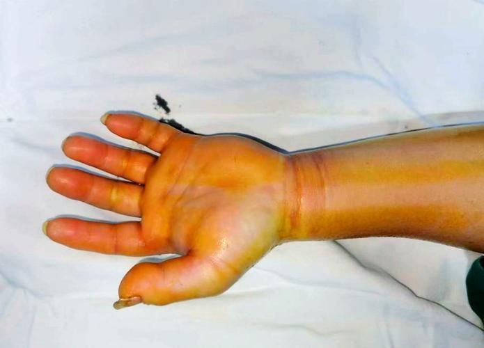 海洋弧菌感染早期圖片，感染海洋弧菌后多久會出現癥狀