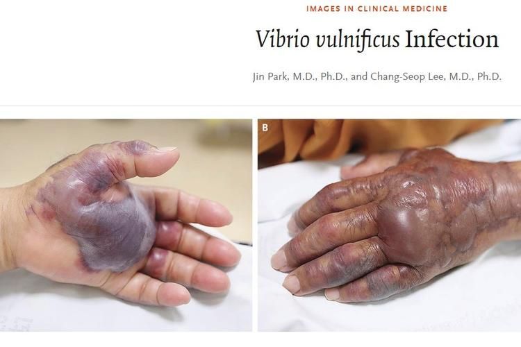 海洋弧菌感染早期圖片，感染海洋弧菌后多久會出現癥狀