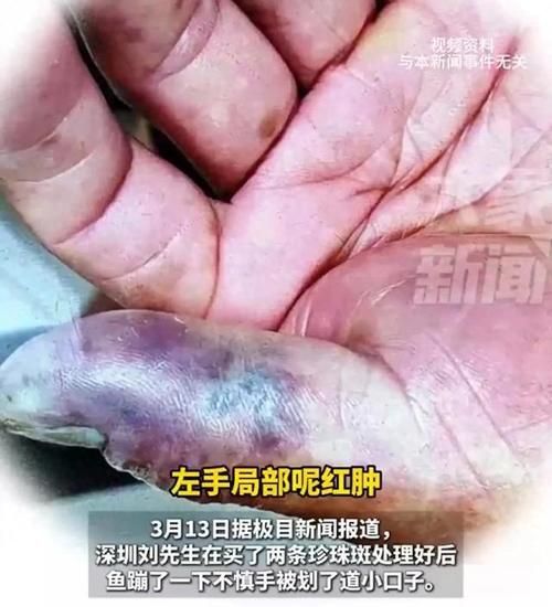 海洋弧菌感染早期圖片，感染海洋弧菌后多久會出現癥狀