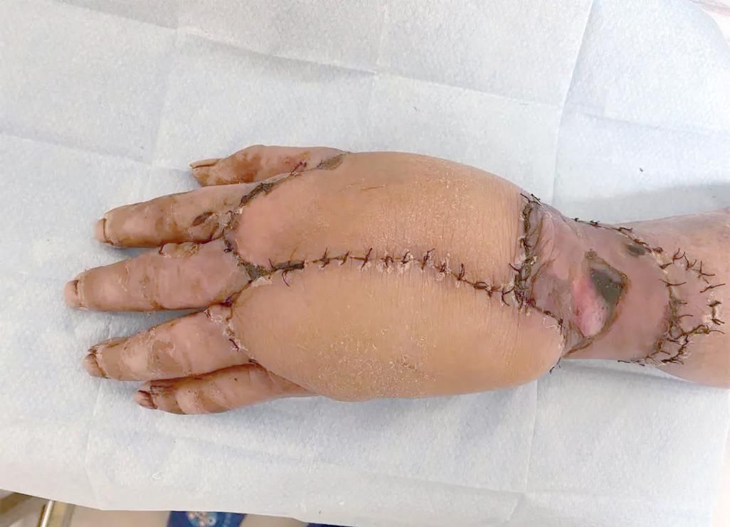 海洋弧菌感染早期圖片，感染海洋弧菌后多久會出現癥狀