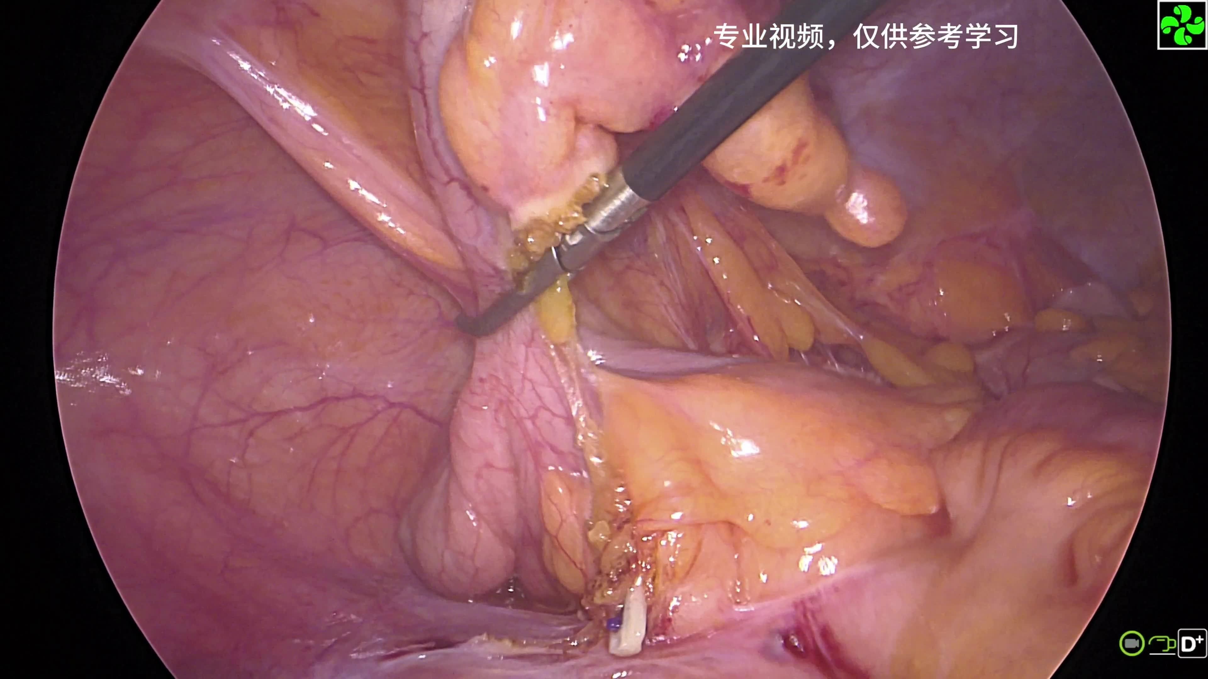 能否提供腹腔鏡闌尾切除術的動態演示，腹腔鏡闌尾切除術全過程嗶哩嗶哩嗶哩嗶哩嗶哩嗶哩