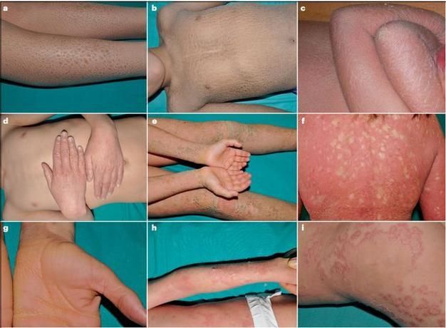 魚鱗珠去除后如何護理，魚鱗珠去除后護理操作圖示