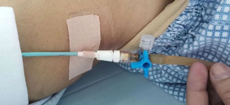 如何降低擠壓或穿刺排液的風險，擠壓或穿刺排液的風險如何降低