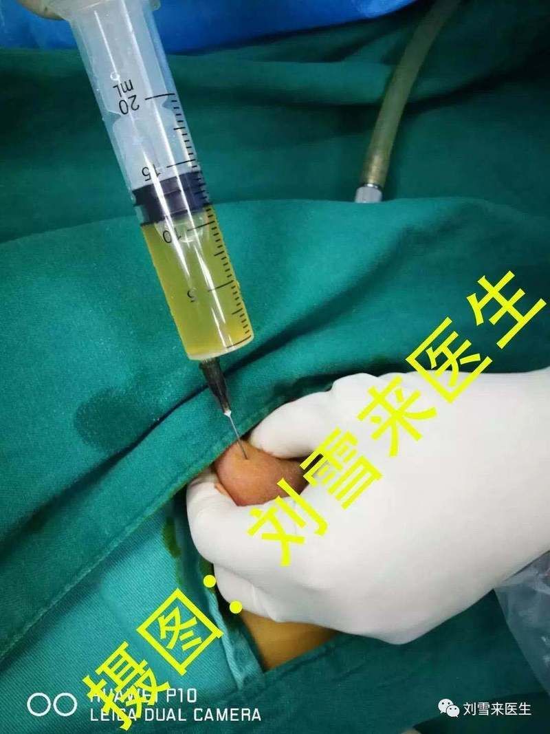 如何降低擠壓或穿刺排液的風險，擠壓或穿刺排液的風險如何降低