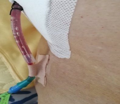 如何降低擠壓或穿刺排液的風險，擠壓或穿刺排液的風險如何降低