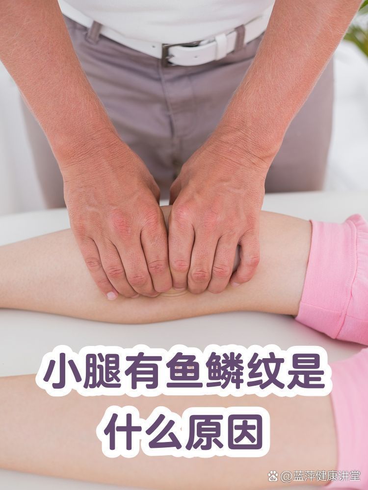 小腿魚鱗紋會(huì)自行緩解嗎，小腿魚鱗紋會(huì)自行消失嗎