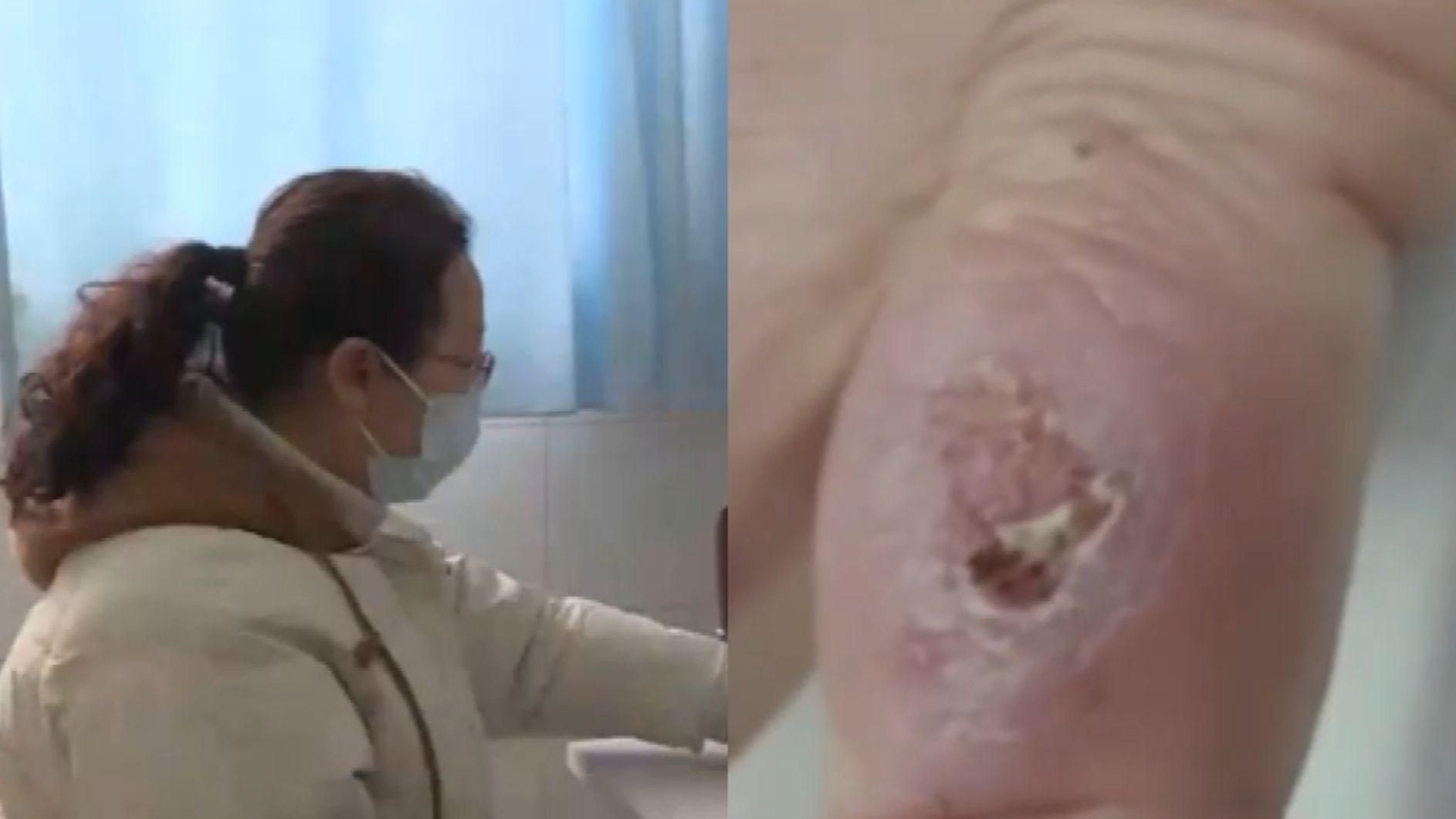 哪種海魚扎傷最容易感染，深圳多人被海魚扎傷后感染風險最高