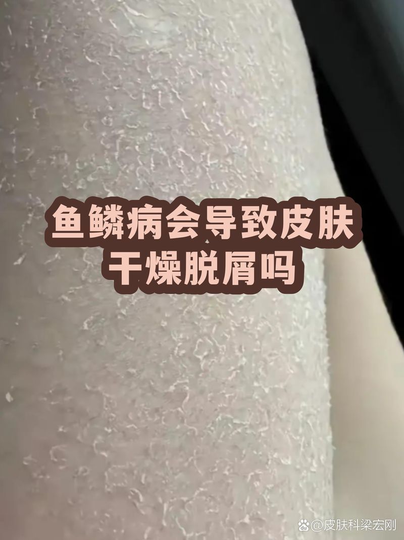 給我一份魚鱗病日常護理清單，皮膚干燥、粗糙和脫屑，魚鱗病患者的日常護理護理
