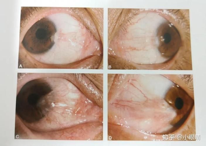 如何判斷魚眼白膜是否嚴重，如何判斷“魚眼白膜”是否嚴重