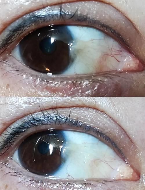 如何判斷魚眼白膜是否嚴重，如何判斷“魚眼白膜”是否嚴重