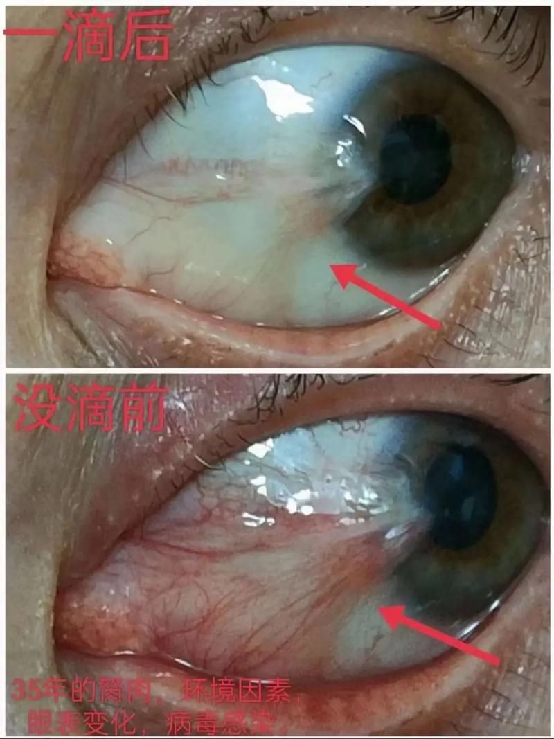 如何判斷魚眼白膜是否嚴重，如何判斷“魚眼白膜”是否嚴重