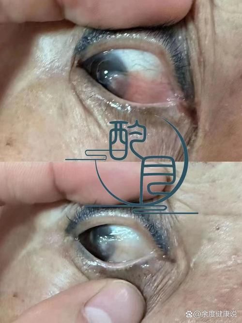 如何判斷魚眼白膜是否嚴重，如何判斷“魚眼白膜”是否嚴重