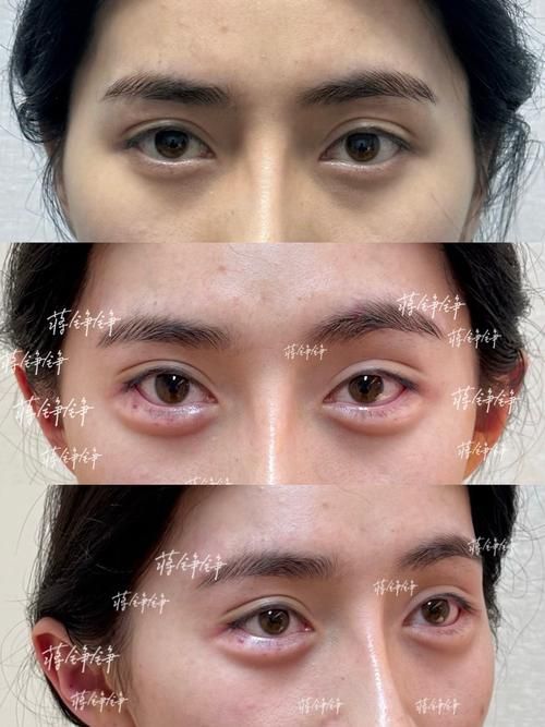 手術治療龍魚腮邊外翻的風險大嗎？，手術治療龍魚腮邊外翻