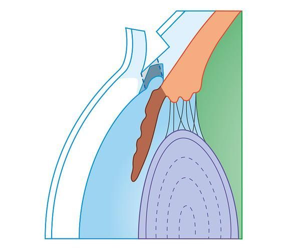 氣蒙眼手術風險大嗎，“氣蒙眼手術”手術風險