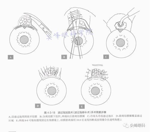 氣蒙眼手術風險大嗎，“氣蒙眼手術”手術風險