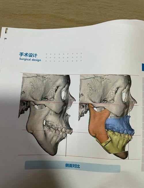 有哪些成功的龍魚咬嘴正骨手術案例，“龍魚咬嘴正骨手術”是否存在的觀賞魚醫療操作