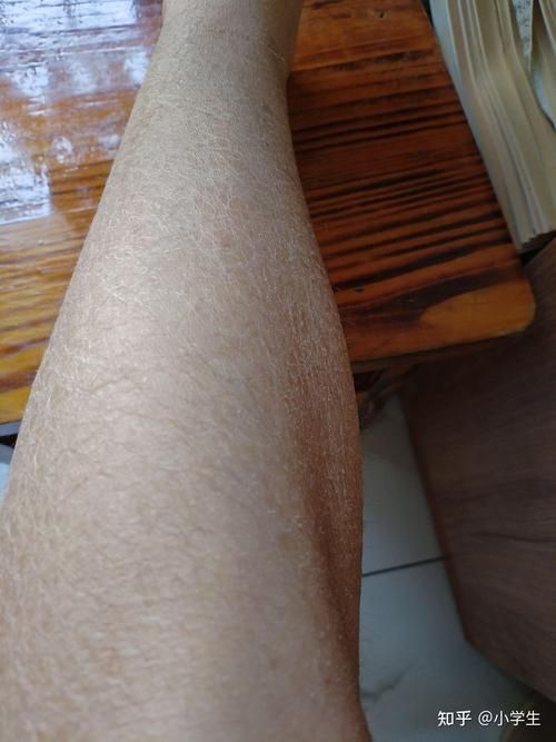 給我一些早期發現魚炸鱗病的圖片，早期發現魚炸鱗病如何治療