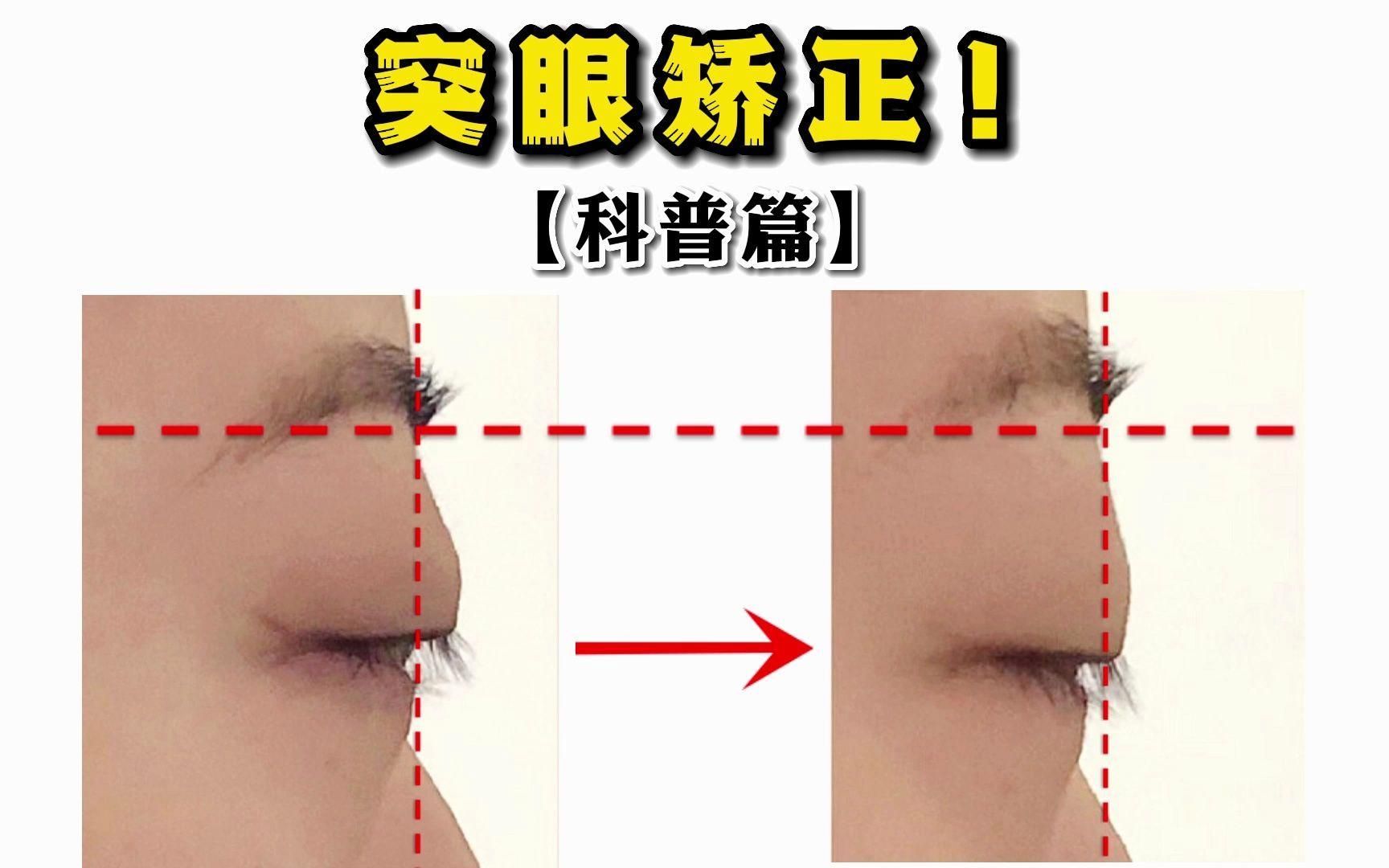 給我一些治療魚突眼的偏方（人類），魚突眼偏方中哪個最有效