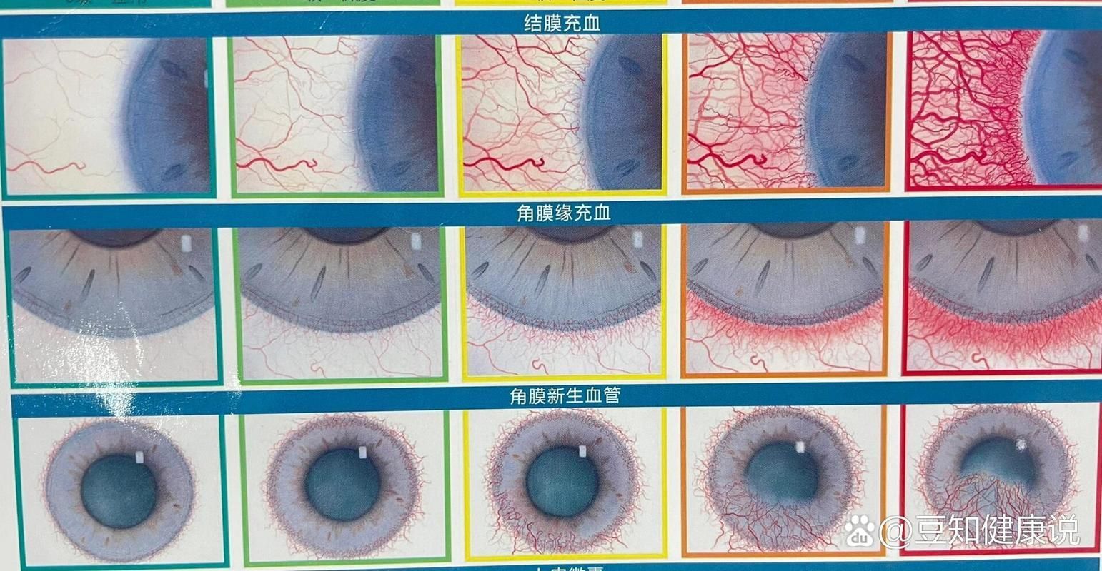 如何區分輕度、中度和重度充血，權威醫學圖譜類圖像與充血（congestion）的區分詳解