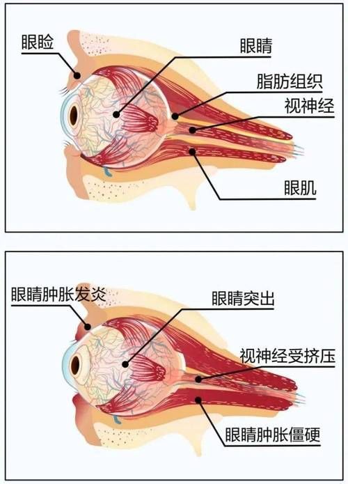 蒙眼和凸眼哪個更嚴(yán)重