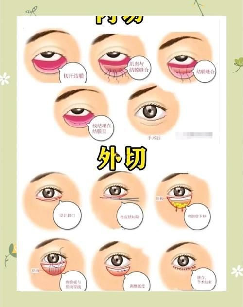 蒙眼和凸眼哪個更嚴(yán)重