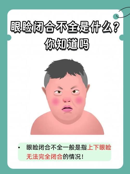 蒙眼和凸眼哪個更嚴(yán)重