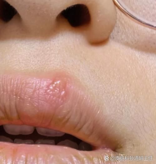 給我更多關于龍魚嘴上皰疹的圖片，龍魚嘴上皰疹怎么辦