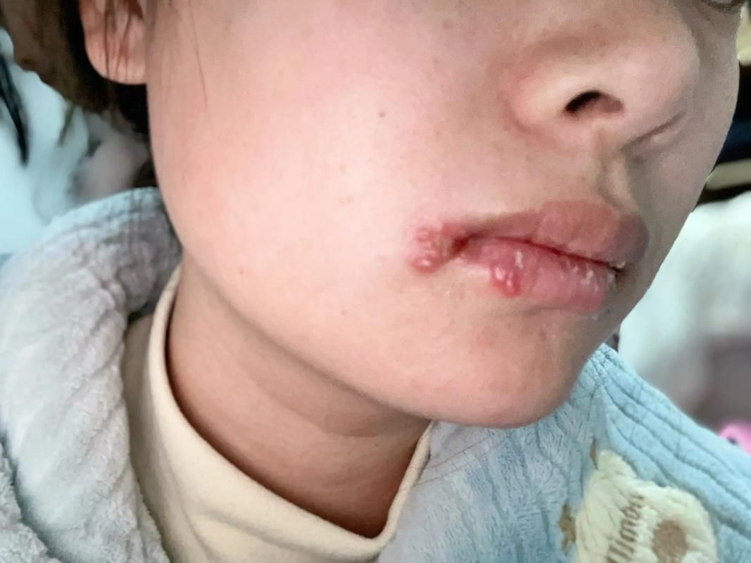 給我更多關于龍魚嘴上皰疹的圖片，龍魚嘴上皰疹怎么辦