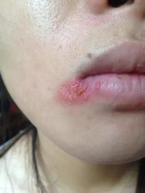 給我更多關于龍魚嘴上皰疹的圖片，龍魚嘴上皰疹怎么辦