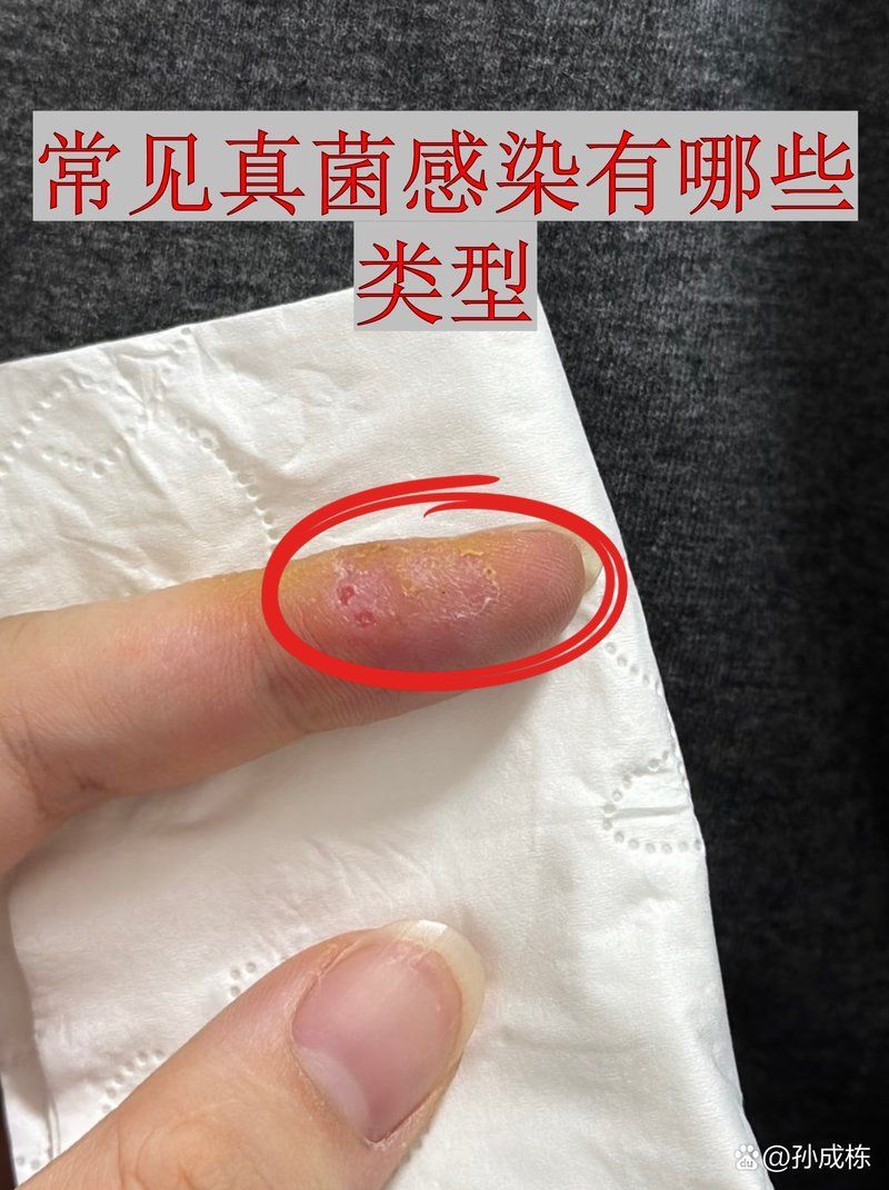 深部真菌感染有哪些常見類型，如何識(shí)別復(fù)雜多樣的深部真菌感染