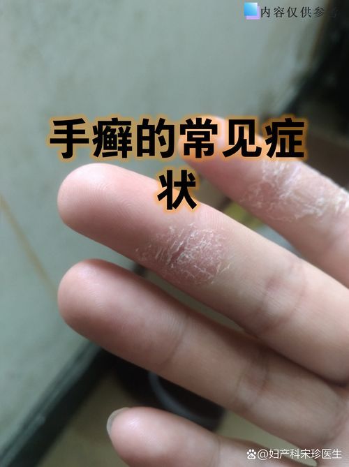 能否提供更多真菌和細菌感染的典型圖片，真菌與細菌感染對比圖鑒，紅龍魚的眼質問題如何判斷