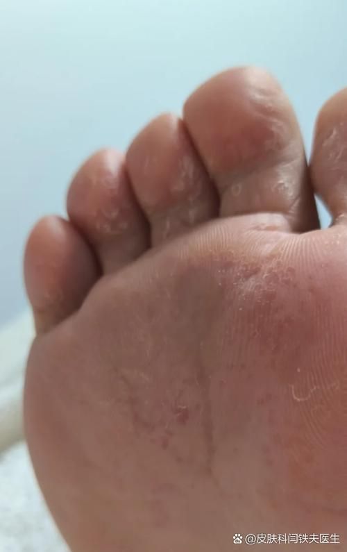 能否提供更多真菌和細菌感染的典型圖片，真菌與細菌感染對比圖鑒，紅龍魚的眼質問題如何判斷