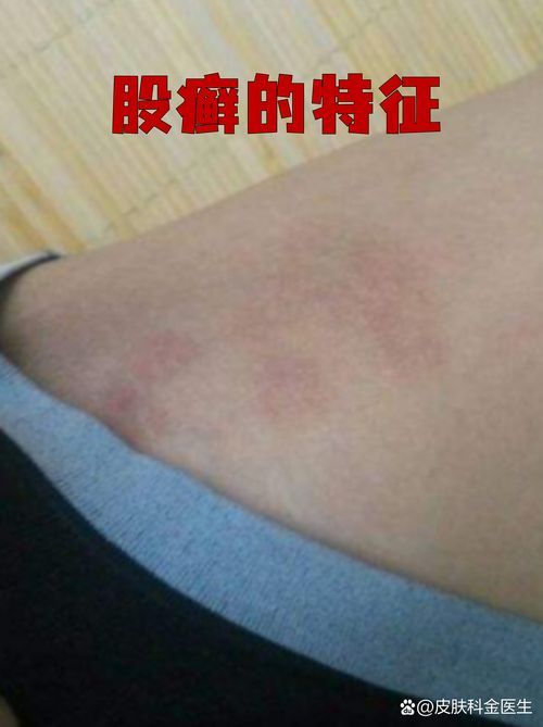 能否提供更多真菌和細菌感染的典型圖片，真菌與細菌感染對比圖鑒，紅龍魚的眼質問題如何判斷
