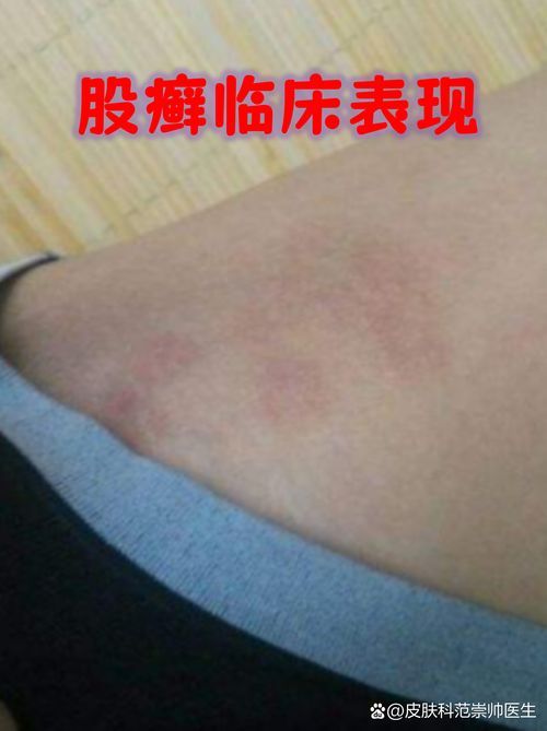 能否提供更多真菌和細菌感染的典型圖片，真菌與細菌感染對比圖鑒，紅龍魚的眼質問題如何判斷