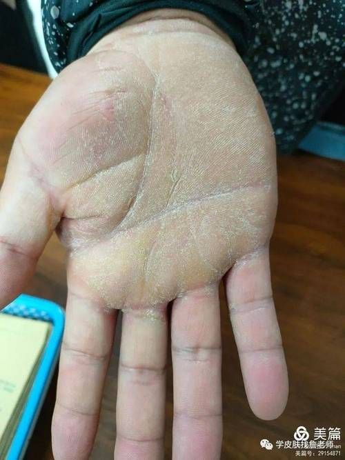 錯鱗和亂鱗哪個更難治療，“錯鱗”與“亂鱗”的區別