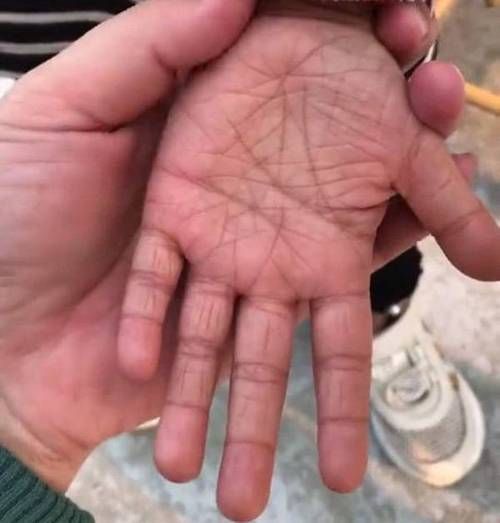 錯鱗和亂鱗哪個更難治療，“錯鱗”與“亂鱗”的區別