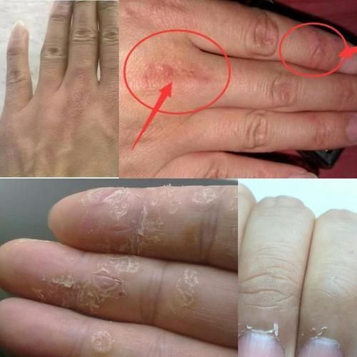 錯鱗和亂鱗哪個更難治療，“錯鱗”與“亂鱗”的區別