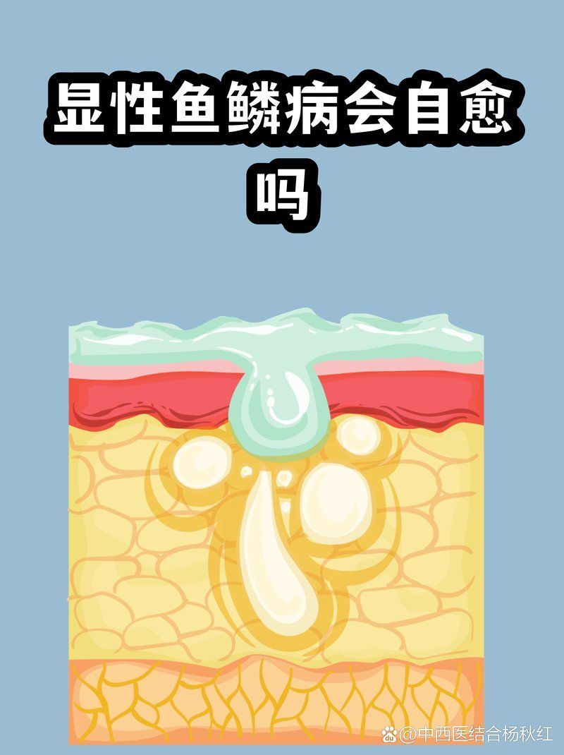 小腿魚鱗紋會自行緩解嗎，小腿魚鱗紋會自愈嗎