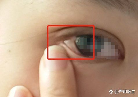 眼睛白膜可以徹底治愈嗎