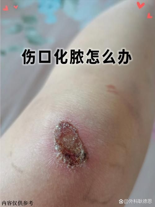 如何預(yù)防海里細(xì)菌感染，關(guān)于海里細(xì)菌感染