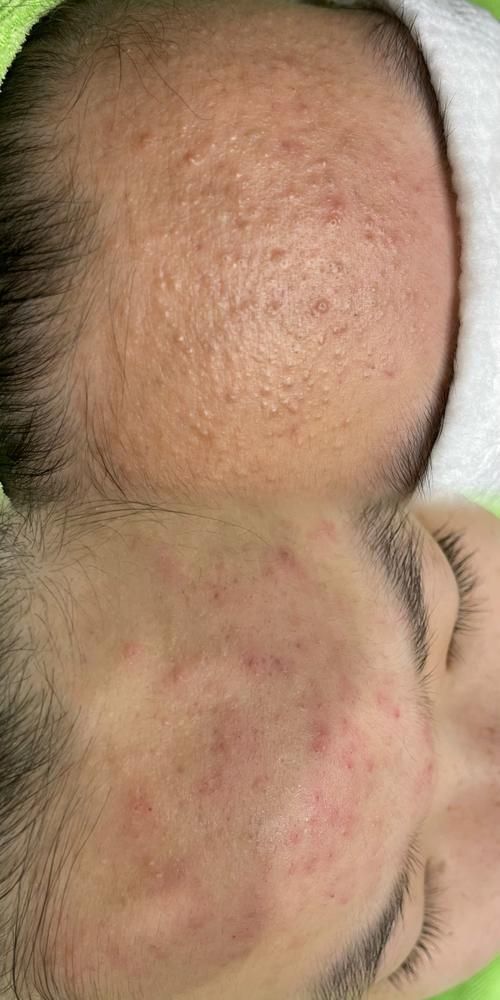 如何判斷碘伏是否完全清除，如何判斷碘伏完全清除